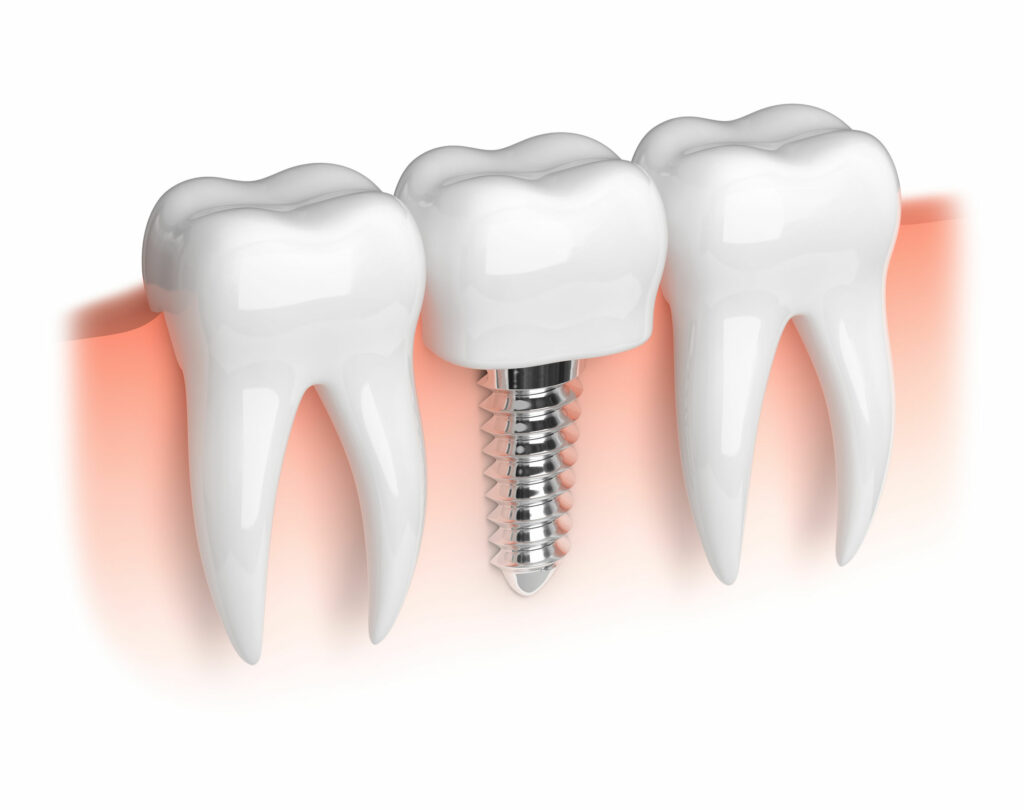 34380457 - model of white teeth and dental implant