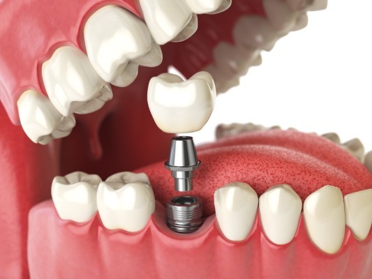 Regain Confidence in your Smile…with Dental Implants