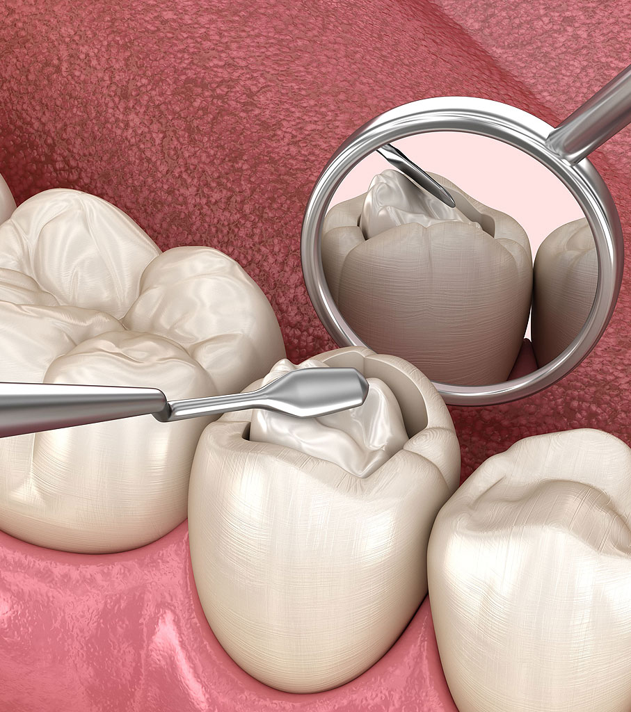 Tooth Fillings - Dentist In Long Prairie, Staples, & Clarissa, MN