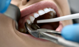 Know about tooth extraction in Hawthorn Woods