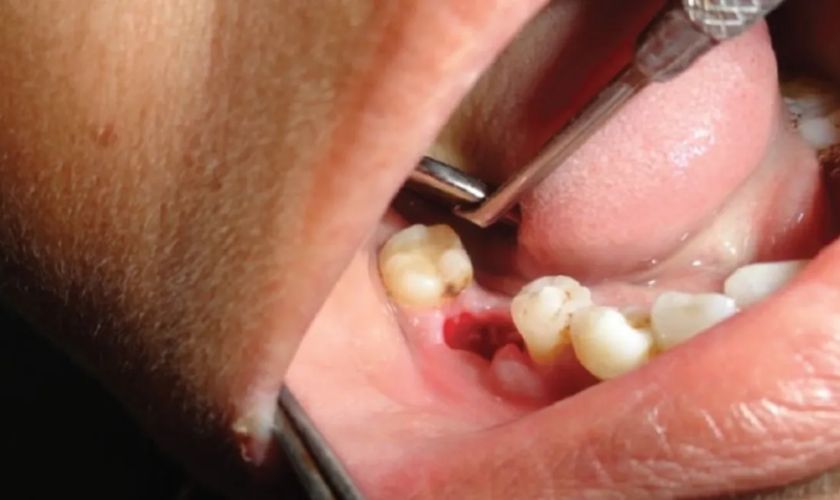 Tooth Extraction in Hawthorn Woods