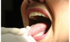 Oral Cancer Screening in hawthorn Woods
