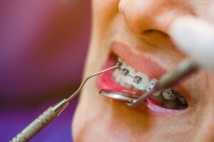 self-ligating braces in Hawthorn Woods, IL