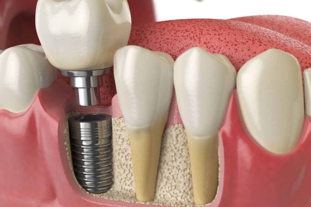 dental-implants-hawthorn-woods-il