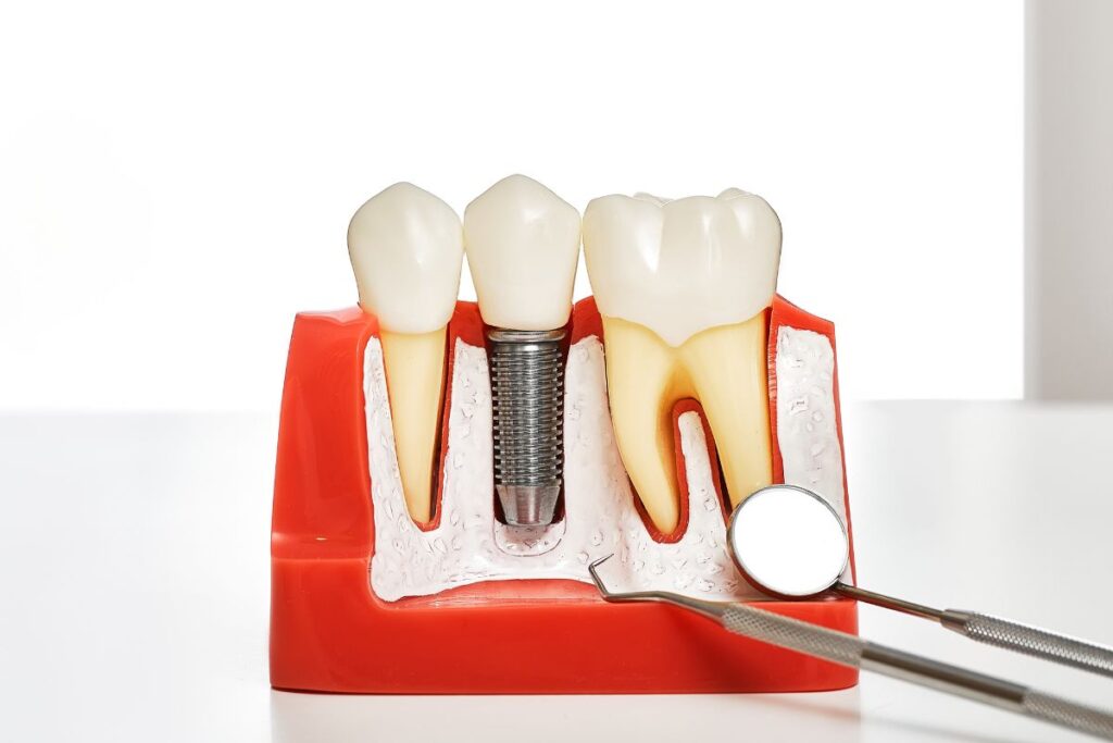 Dental Implants in Hawthorn Woods, IL