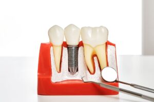 Dental Implants in Hawthorn Woods, IL
