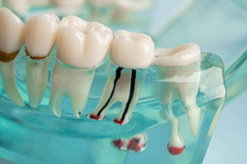 root-canal-therapy-hawthorn-woods-il