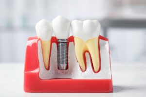 dental-implants-for-smokers-hawthorn-woods