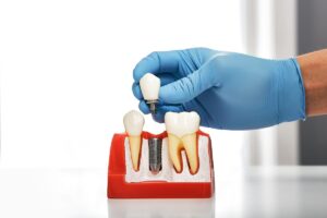 Dentist holding dental implant crown above model showing tooth extraction site and jawbone structure.